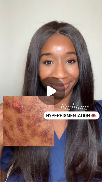 Tyrosinase Inhibitors, Acne Hyperpigmentation, Post Inflammatory Hyperpigmentation, Acne Dark Spots, Keratosis Pilaris, Lighten Dark Spots, Acne Solutions, Acne Care, Kojic Acid