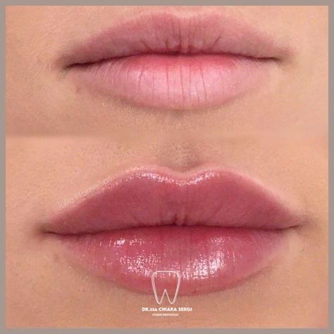 Lip Injections Natural Look, Good Lip Filler Pictures, Lip Filler For Hydration, Lip Fuller Shapes, Light Lip Injections, Simple Lip Fillers, Before And After Lip Fillers Small Lips, Different Types Of Lip Fillers, Lip Injection Inspiration