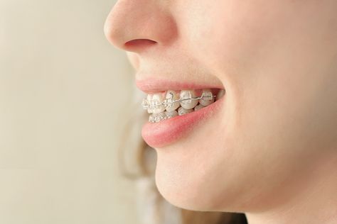 Pre-Braces Party: What To Eat Before Brackets & Wires #braces #party #foods #celebrate Braces Before And After, Braces Food, Getting Braces, Teeth Alignment, Traditional Braces, Jaw Surgery, Dental Braces, Straight Teeth, Dental Center