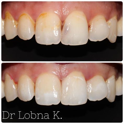 Dr. Lobna Khardani on Instagram: “Composite fillings 💫🦷” Composite Fillings, Composition, On Instagram, Instagram