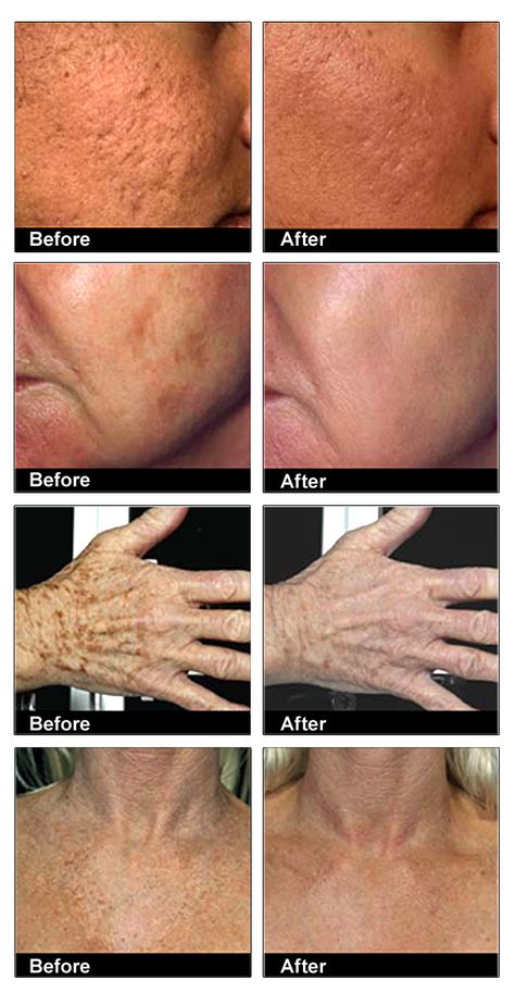 Get Rid Of Age Spots, Age Spot Remedies, Age Spots On Face, Acne Scar, Arbonne, Age Spots, Perfect Makeup, Anti Aging Skin Products, Simple Skincare