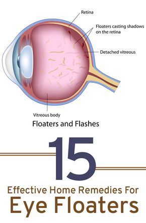 Eye Floaters Remedies Natural Treatments, Castor Oil For Eye Floaters, Eye Floaters Remedies, Floaters In The Eye, What Causes Eye Floaters, Eye Floaters Causes, Eye Health Remedies, Eye Floaters, Pinterest Tutorial