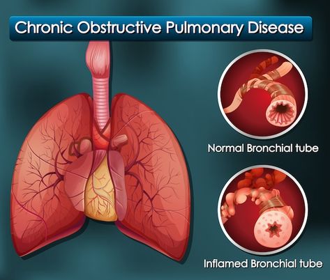 Free vector diagram showing chronic obst... | Free Vector #Freepik #freevector #lungs #lung-disease #physiology #human-lungs Boehringer Ingelheim, Natural Face Cleanser, Baking Soda Cleaning, Chronic Obstructive Pulmonary Disease, Pulmonary Disease, Trend Analysis, Brain Food, Types Of Cancers, Lungs