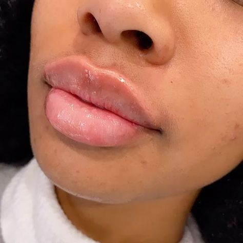 Fabulous work! 💋 Lip Filler injections by master injector Shannon Synoracki @injector_shannon 💉❤️ * free consultation 🎁 #staytuned #lip #lipfiller #hyaluronicacid #sexylips #injections #dmv #goodlips #glossylips #likeforlikes #inlove #medspa #dermalfillers #dc #md #mcleanva Lip Fillers On Black Women, Lip Injections Aesthetic, Lips Inspiration, Facial Fillers, Injectables Fillers, Lip Filler, Botox Fillers, Glo Up, Cupids Bow