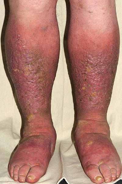 causes Swollen Legs Remedies, Leg Ulcers, Subcutaneous Tissue, Swollen Legs, Blood Sugar Diet, Poor Circulation, Daily Health Tips, Support Network, Fitness Advice