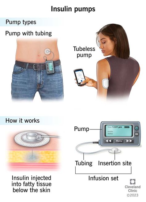 Insulin Pump Aesthetic, Pump Aesthetic, Types Of Insulin, Wearable Medical Devices, Insulin Pump, Study Board, School Study, Skin Clinic, Pump Types