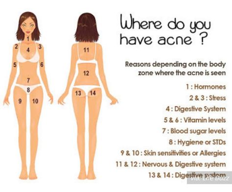 Acne And What It Means, Burn Remedy, Body Chart, Natural Acne Remedies, Natural Acne, Body Acne, Natural Healing Remedies, Leg Pain, Cystic Acne