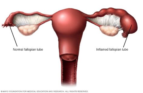 Pid Symptoms, Pelvic Inflammatory, Fertility Testing, Ectopic Pregnancy, Fallopian Tubes, Polycystic Ovaries, Medical Tests, Pelvic Pain, Mayo Clinic