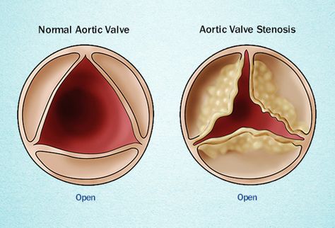 Aortic Valve Stenosis, Heart Catheterization, Aortic Valve Replacement, Cardiac Disease, Clogged Arteries, Heart Valves, Heart Defect, Cardiac Nursing, Heart Surgery