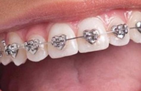 Cute Braces, Brace Face, Braces Colors, Tooth Gems, Teeth Braces, Tooth Gem, Teeth Jewelry, Glo Up, Body Mods