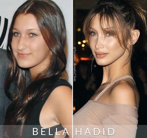 Bella Hadid Before and After Before After Plastic Surgery Faces, Alarplasty Before After, Bella Hadid Surgery, Plastic Surgery Celebrities, Bella Hadid Nose, Plastic Surgery Aesthetic, Face Plastic Surgery, Nose Surgery Rhinoplasty, Celebrity Surgery