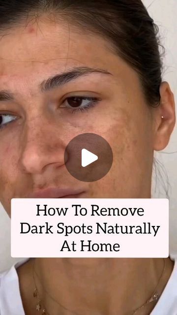 Fading Cream Dark Spots, How To Get Rid Of Brown Spots On Face, Diy For Dark Spots On Face, Face Darkness Removal, Removing Dark Spots On Face, How To Remove Dark Spots On Face At Home, How To Remove Black Dots On Face, Home Remedies For Dark Spots, How To Reduce Dark Spots On Face