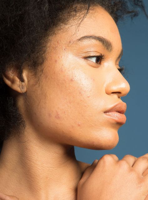 5 Awesome YouTube Tutorials That'll Teach You How To Hide Acne #refinery29  http://www.refinery29.com/best-acne-makeup-tutorials-youtube Face Mapping Acne, Forehead Acne, Acne Prone Skin Care, Acne Makeup, Black Skin Care, Acne Skincare Routine, Severe Acne, Acne Scar Removal, How To Apply Mascara