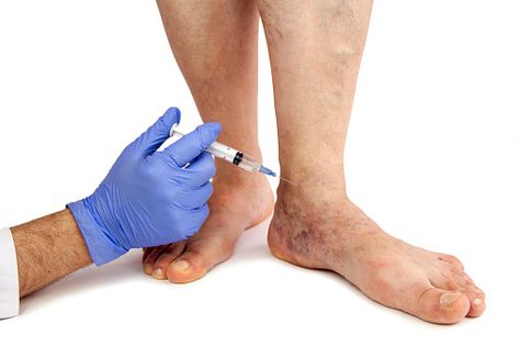 An explanation of chronic venous insufficiency, medical options, and dietary suggestions Chronic Vein Insufficiency, Annette Marie, Vascular Ultrasound, Varicose Vein Remedy, Leg Veins, Coronary Artery, Venous Insufficiency, Turmeric Vitamins, Foot Exercises