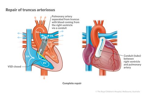 April | 2016 | PAINE Podcast and Medical Blog Chd Mom, Cleft Lip And Palate, Heart Warrior, Money For Nothing, Reducing Blood Pressure, Congenital Heart Defect, Heart Defect, Healthy Blood Pressure, Cardiology