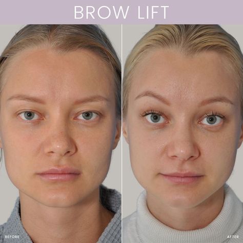 Brow Lift Before and After Temporal Brow Lift, Eyelid Lift Before After, Eyebrow Lift Before And After, Latisse Before And After, Thread Lift Face Before And After, Botox Eyebrow Lift Before And After, Brow Lift Before And After, Eyebrow Lift Botox Before And After, Botox Brow Lift Before And After