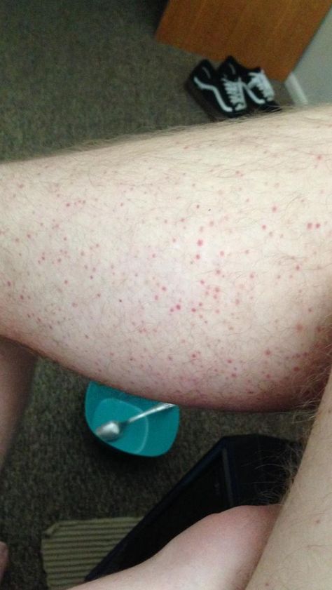 [skin concerns] Can someone PLEASE help me? These red dots showed up on my legs a few days ago and I have no idea what they are or how to get rid of them. Red Moles, Clear Skin Routine, Healthy Lifestyle Quotes, Baking Soda Shampoo, Please Help Me, Skin Tips, Health Facts, Skin Concern, Red Dots