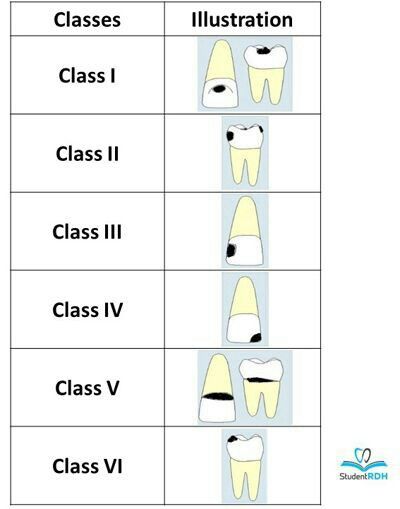 Gv Black Caries Classification, Dental Charting Symbols, Pediatric Dental Assistant, Dental Assistant Study Guide, Dental Charting, Registered Dental Assistant, Dental Assistant School, Dental Hygienist School, Hygiene School