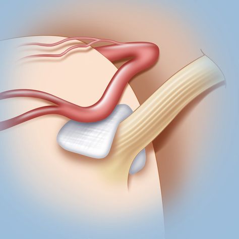 Hemifacial spasm | Microvascular decompression surgery for hemifacial spasm Trigeminal Nerve, Bells Palsy, Facial Anatomy, Facial Nerve, Types Of Surgery, Jaw Pain, Mri Scan, The Nerve, Patient Experience