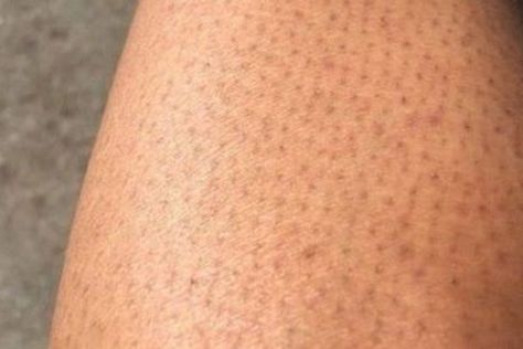 Strawberry Legs Aesthetic, Leg Scars, Strawberry Skin, Glove Design, Thick Hair Growth, Strawberry Legs, Chemical Exfoliation, Dry Flaky Skin, Smooth Legs