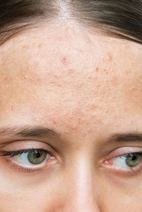 Types Of Acne On Face, Acne Textured Skin, Acne On Back, Closed Comedones, Natural Remedies For Acne, Comedonal Acne, Cystic Acne Remedies, Remedies For Acne, Forehead Acne