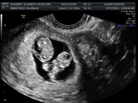 10 Weeks Pregnant Ultrasound, 7 Week Ultrasound, Twins Ultrasound, Pregnant Ultrasound, 10 Weeks Pregnant, Medical Ultrasound, 4d Ultrasound, Baby Ultrasound, Twin Pregnancy