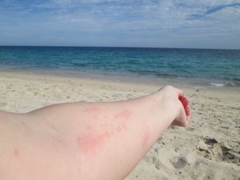 5 Things to Know about Jellyfish at the Beach - Swim Guide Jellyfish Species, Jellyfish Sting, Sting Relief, Fish Bites, Beach Stuff, Chill Photos, Jelly Fish, Beach Swim, Water Quality