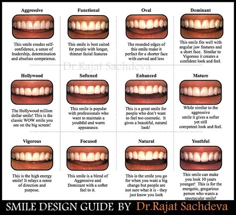 Smile Design Dental Teeth, Different Types Of Smiles, Smile Design Dental, Free Dental Implants, Dental Smile, Design Analysis, Cosmetic Dentistry Procedures, Dental Aesthetics, Dental Implants Cost