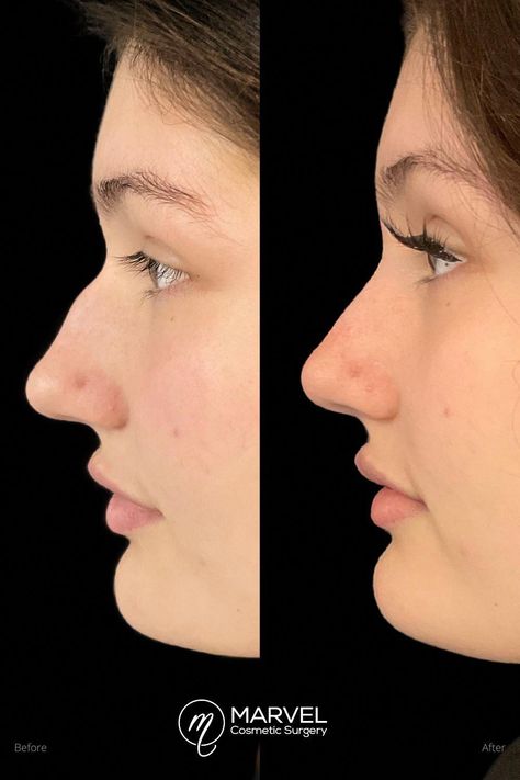 Bump Nose Bridge, Nose Hump Aesthetic, Straight Nose With Bump, Dorsal Hump Rhinoplasty, Dorsal Hump Nose, Straight Nose Bridge, Nose Bump, Rhinoplasty Before And After, Nose Picking