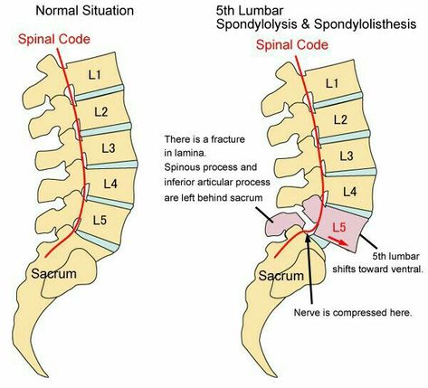 Pars Defect, Lumbar Spondylosis, L5 S1, Nerve Anatomy, Spinal Surgery, Sports Therapy, Yoga Anatomy, Spine Health, Spine Surgery