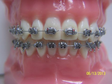 Braces Journey, Blue Braces, Braces Care, Silver Braces, Kids Dental Health, Braces Bands, Adult Braces, Getting Braces, Teeth Alignment