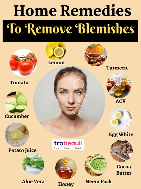 How To Get Rid Of Blemishes At Home [Home Remedies] - Trabeauli Forehead Acne, Potato Juice, Acne Overnight, Oily Skin Care Routine, Natural Acne Remedies, Physical Appearance, Blemish Remover, Baking Soda Uses, Beauty Diy