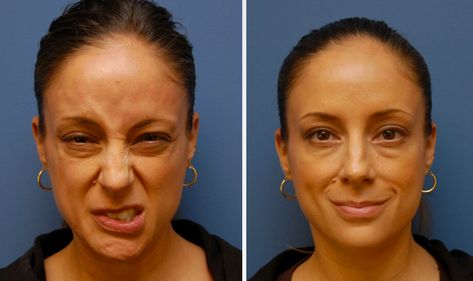 Exercises for Bell’s Palsy Facial Muscle Exercises, Endoscopic Brow Lift, Bell’s Palsy, Facial Paralysis, Nerve Disorders, Bells Palsy, Doctor Shows, Facial Nerve, Effective Exercises