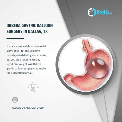 #gastiricballoon #weightloss surgery Gastric Surgery Diet, Orbera Balloon, Gastric Balloon, Gastric Bypass Revision Surgery, Gastric Surgery, Preparing For Gastric Surgery, Gastric Problem, Balloon Weights, Be The Best