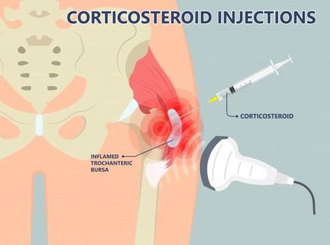 Greater trochanteric pain syndrome - cortisone injections Iliopsoas Bursitis, Greater Trochanteric Pain Syndrome, Gluteus Minimus, Examination Room, Platelet Rich Plasma Therapy, Greater Trochanter, Iliotibial Band, Sports Physical Therapy, Bursitis Hip