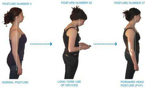 correcting cervical lordosis Cervical Lordosis, Neck Hump, Text Neck, Forward Head Posture, Orthotic Shoes, Neck Injury, Neck Exercises, Bad Posture, Neck And Back Pain