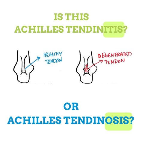 Achilles Tendon Pain Relief, Achilles Tendon Strengthening Exercises, Achilles Bursitis, Strengthen Achilles Tendon, Ruptured Achilles, Insertional Achilles Tendinosis, Achilles Stretches, Achilles Tendon Ruptures, Achilles Tendinopathy