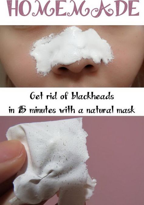 Obličejové Masky, Make Up Diy, Rid Of Blackheads, Natural Mask, Face Mask Recipe, Get Rid Of Blackheads, Beauty Remedies, Homemade Face Masks, Homemade Face