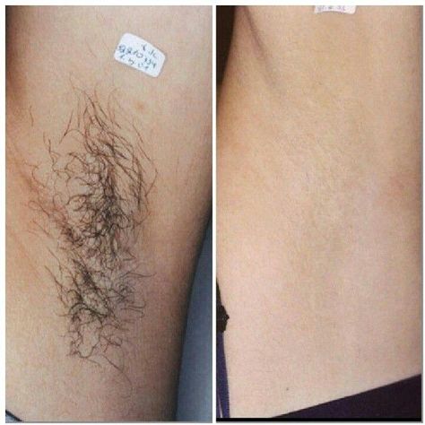 Hair Removal Diy, Underarm Odor, Underarm Hair Removal, Home Hair, At Home Hair Removal, Botox Injections, Hair Removal Methods, Dental Cosmetics, Laser Tattoo Removal