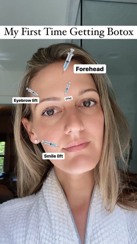 Wrinkle Between Eyebrows, Botox Eyes, Botox Under Eyes, Botox Forehead, Botox Brow Lift, Natural Botox, Botox Before And After, Face Fillers, Botox Lips