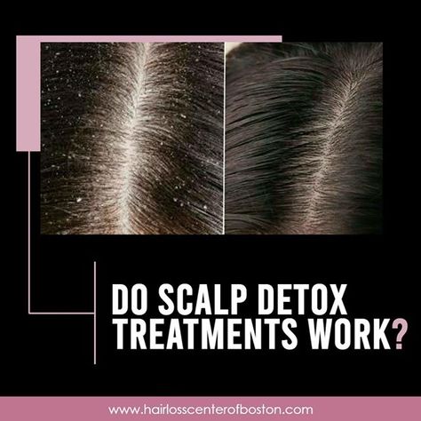 By detoxing the scalp you can reach deep within the pores and cleanse them while getting rid of impurities and Excess build-up that will clog the follicles and may cause hair loss and scalp maladies at the same time. --------------------------- Book an appointment online  https://ift.tt/2DSTzJH . . . . . #hairlosscenterofboston #stylists #haircutting #surgicalhairreplacement #haircoloring #keratintreatment #blowdrys #hairrestoration #pureology #olaplex #keratincomplex #hairmatters #hairpro #hair Keratin Complex, Hair Restoration, Boston, Hair Color, Canning, Hair, Hair Colour