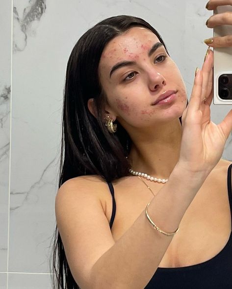 Girl With Acne, Daisy Acrylic Nails, Celebrity Acne, Acne Prone Skin Care, Bad Acne, Chic Nail Art, Acne Studio, Acne Scar Removal, Best Serum