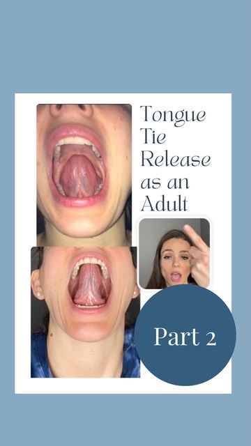 Margaret Barry• FNTP, CPT, PCES on Instagram: "Part 2 of this series, talking about my experience with a tongue release as an adult!❓❓Question: would you have a knee replacement, and skip the rehabilitative therapy before and after the surgery? I hope not!! Likewise, it is important to undergo preparatory measures ahead of and after a tongue tie release. I believe the preparation I did with the rest of my body and tissues (myofunctional therapy, myofascial release, and cranial work) allowed me t Tongue Tie Release, Tongue Tie Exercises, Mewing Before And After, Mewing Tongue Posture, Tongue Exercises, Orofacial Myofunctional Therapy, Jawline Exercise, Myofunctional Therapy, Facial Bones