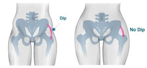 Hips Dips Before And After, What Are Hip Dips, Rid Of Hip Dips, Hip Anatomy, Dip Workout, Handmade Halloween Costumes, Fat Grafting, Red Spider Lily, Hips Dips