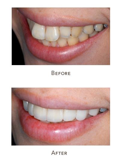 After Braces, Fix Teeth, Buck Teeth, Teeth Alignment, Traditional Braces, Dental Restoration, Tooth Repair, Teeth Straightening, Straight Teeth