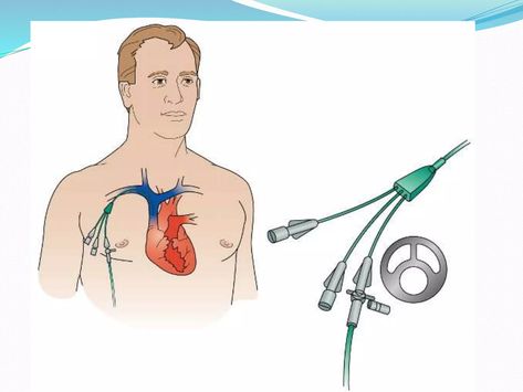 Central Venous Catheter, Valsalva Maneuver, Drawing Blood, Central Line, Increase Heart Rate, Meta Analysis, Hand Hygiene, Nursing, For Free