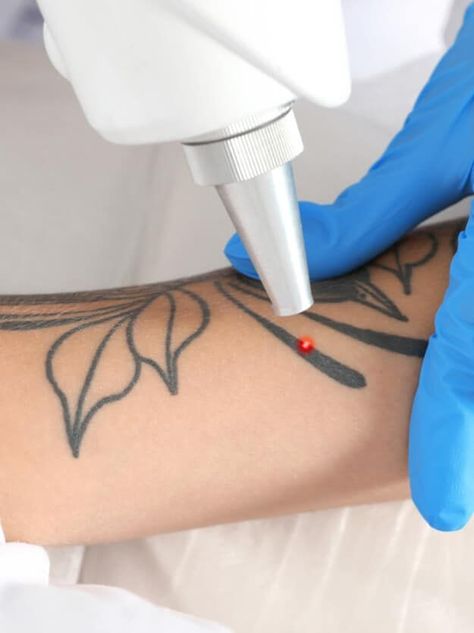 Skin Design Tattoo Removal Tattoo Removal Cream, Tattoo Removal Cost, Tattoo Off, Laser Removal, Laser Hair Removal Machine, Laser Clinics, Hair Removal Machine, About Tattoo, Laser Tattoo