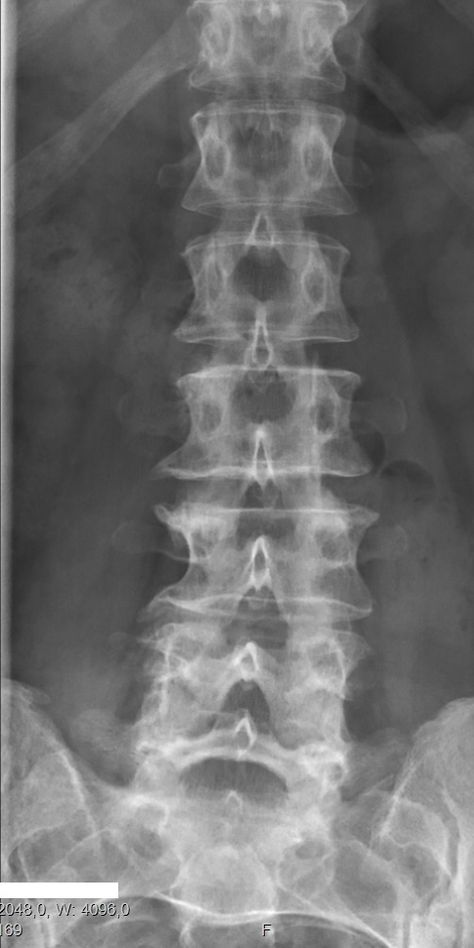 Decayed Flowers, X-ray Images, Spinal Surgery, Bone Diseases, Spine Health, Animals Pictures, Medical Knowledge, Buddha Image, Radiology