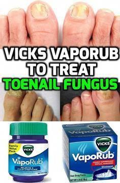 What Are the Health Uses of Vicks Vaporub? - People sometimes ask us what Vicks Vaporub health uses are, and we can give them a short answer: it is a natural cough and cold reliever that have no side... Vicks Vapor Rub, Vicks Vapor, Vicks Vaporub Uses, Toenail Fungus Remedies, Uses For Vicks, Cough Suppressant, Vapor Rub, Tongue Health, Vicks Vaporub