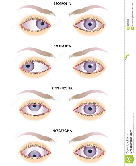 Strabismus - Download From Over 45 Million High Quality Stock Photos, Images, Vectors. Sign up for FREE today. Image: 28300621 Eye Anatomy Notes, Optometry Education, Anatomy Notes, Optometry School, Eye Facts, Eye Anatomy, Vision Therapy, Medical Student Study, Medicine Student